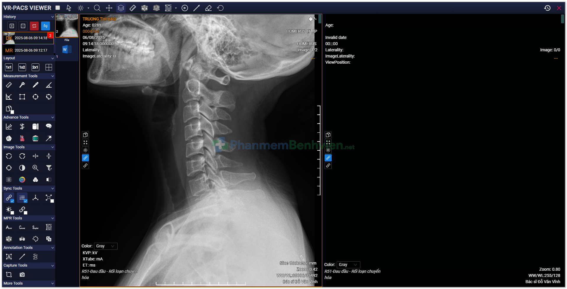 Hình ảnh chẩn đoán hình ảnh PACS từ phần mềm bệnh viện (PhanmemBenhvien.net)