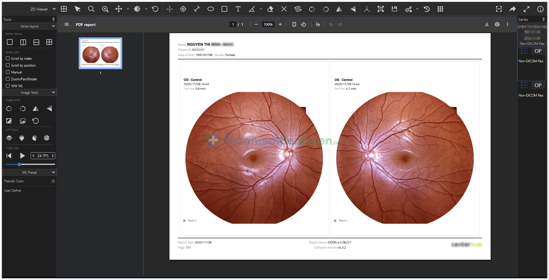 Hình ảnh chụp đáy mắt màu từ phanmembenhvien.net
