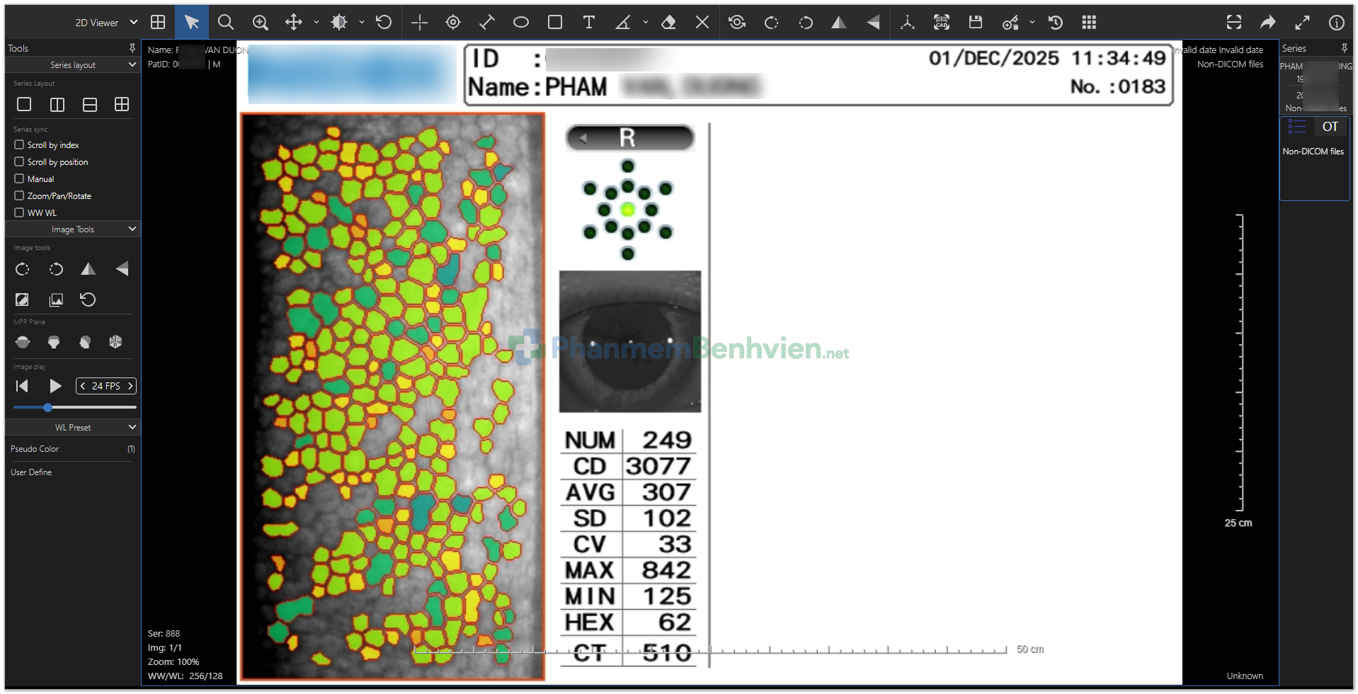 Hình ảnh đếm tế bào nội mô mắt