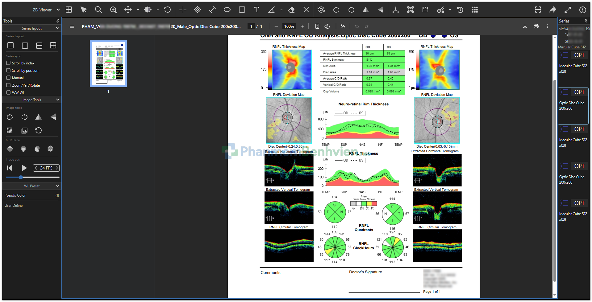 Hình ảnh chụp OCT mắt phải từ Phần mềm bệnh viện