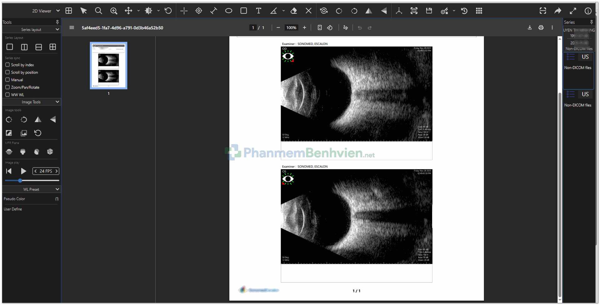 Siêu ấm chần đoán A/B 2 mắt