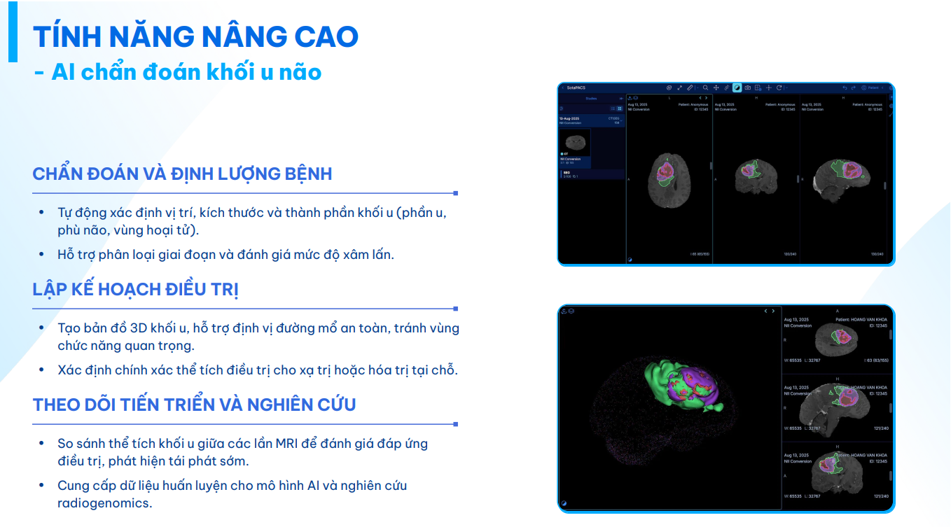 AI chẩn đoán khối u não